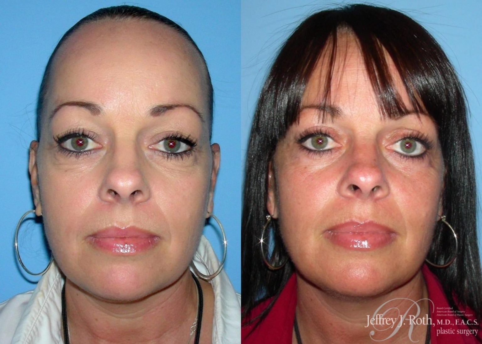 The Main Differences Between Eyelid Surgery Blepharoplasty Vs Brow Lift 1165